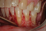 Figure 4  Site analysis (tooth No. 22) at the time of surgery.