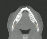 Figure 5  Orientation for orthodontic space analysis in the axial plane at the level of the osseous crest.