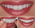 Figure 2  By inserting the laboratory fabricated trial smile, the patient was able to consider phonetic function and show friends and family the appearance of the new teeth.