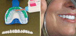 Figure 3B  View of the chairside fabrication of a trial smile (inserts from Adar DVD, Trial Smile, distributed by National Lab Network).