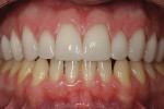 Figure 5E  View of the nine porcelain laminate veneers and one all-ceramic crown after cementation.