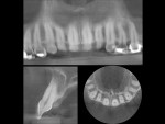 Figure 8  Collage of tooth No. 7.