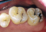Figure 3A  Occlusal and lingual pit and fissure caries are evident on the maxillary second premolarand the first and second molars.