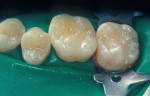 Figure 5  The minimally invasive preparations were restored with flowable composite resin;<sup>f</sup> the more extensive preparations were restored with apackable composite resin.<sup>g</sup>