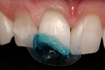 Figure 6A  The enamel is etched in this ClassIV incisal edge fracture.