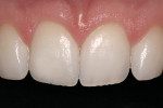 Figure 6B  The incisal edge fracture is restored with an etch-and-rinse adhesive and nanohybrid composite resin.<sup>h</sup>