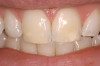 Fig 3. Eight months later, diastemas have developed between the mandibular second and first molars.