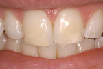 Figure 7A  View of the discolored maxillary central incisors.