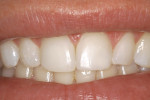 Figure 7B  The maxillary incisors are restored with direct nanohybrid composite veneers.<sup>i</sup>