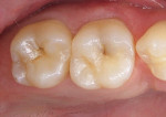 Figure 8A  This preoperative view shows occlusal pit and fissure caries on the maxillaryfirst and second molars.