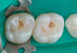 Figure 8B  The occlusal surfaces were prepared.