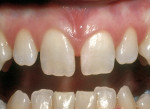 Figure 9A: Diastemas present between the maxillary incisors, which the patient desires to close without orthodontic treatment.