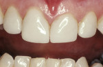 Figure 9B: View of the minimally invasive porcelain veneersk of the restored maxillary  incisors at the 22-year recall.