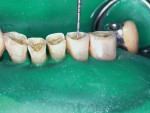 Figure 11  The dentin is prepared to a depthof 1.0 mm to ensure adequate composite resin longevity.