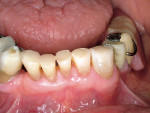 Figure 12  This restoration of the worn incisaledges using a nanohybrid composite resinnincorporated an etch-and-rinse technique.