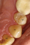 Figure 12  represent Class A RSBI on the lingual aspects of teeth Nos. 10, 11, and 12. The facial aspect of No. 12 represents a Class B RSBI (Figure 13). Note adequate soft tissue support at the CEJ.