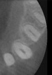 Figure 13  represent Class A RSBI on the lingual aspects of teeth Nos. 10, 11, and 12. The facial aspect of No. 12 represents a Class B RSBI (Figure 13). Note adequate soft tissue support at the CEJ.