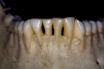 Figure 15  Class A RSBI for the facial aspects of teeth Nos. 19 to 21, Class B RSBI for tooth No. 25, and Class C RSBI for teeth Nos. 22 to 24, 26, and 27.