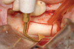 Figure 5  Block graft harvest and apical horizontal cut performed with angled saw-like insert, which created very precise and narrow bone incisions.