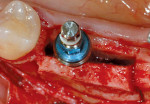 Figure 6  Expansion of ridge to facilitate ideal implant positioning.