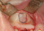 Figure 7A  Lateral window sinus osteoplasty with radiograph showing simultaneous extraction of primary tooth, implant site development, and sinus graft.
