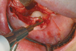 Figure 10B  Torus removal with Piezosurgery saw-like insert. A Exposure of torus. B Incision being completed. C Separation of torus by osteotomy with bone saw-like insert.