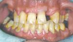 Figure 3  Buccal intraoral view at presentation. Note large accumulations of plaque and calculus with severe marginal gingivitis. Class I cuspid relationship was noted with signs of posterior bite collapse and loss of occlusal vertical dimension.