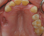 Figure 4  Occlusal view of maxillary jaw at presentation. The patient recently lost tooth No. 3.