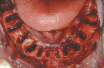 Figure 13  Mandibular extraction sites. Note buccal bone preservation as in maxillary jaw.
