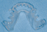 Figure 14  Surgical guide template for the man­dibular jaw, which was used as a bite registration at the laboratory to mount the case in the proper position.
