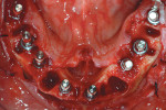 Figure 15  Implant surgical sites used: tooth No. 18, mesial root site Nos. 19, 20, 24, 26, 28, 30, and 31. Note osseous defect in the area of teeth Nos. 22 and 23, which made site No. 23 unusable.