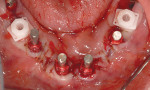 Figure  19   Closed tray WN synOcta impression coping in place for molar site Nos. 19 and 30, and open tray synOcta for RN sites. Site Nos. 18 and 31 were left to heal without loading.
