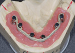 Figure 22  Laboratory model of mandibular case with casted bar in place, which gave significant strength to the screw-retained provisional.