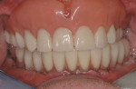 Figure 25  Insertion of lower screw-retained fixed provisional 4 days after surgery. Note sutures are still in place. Patient had very little postsurgical morbidity.