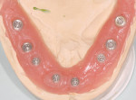 Figure 28  Laboratory model of lower case. Note level prosthetic shoulders of all implant sites. This was the result of proper surgical 3-dimensional placement after significant osteoplasty to level the bony discrepancies.