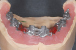 Figure 29: Framework of final case after intraoral luting of three sections with fast-set acrylic. Seating was confirmed previously with periapical radiographs.