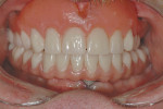 Figure 31  Final buccal intraoral view at insertion.