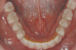 Figure 32  Final occlusal intraoral view at insertion.