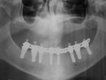 Figure 33  Panoramic radiograph of completed case a few days postinsertion.