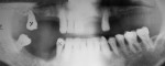 Figure 1A  Initial presentation radiograph of a 53-year-old man before removal of periodontally compromised maxillary molar and implant placement.
