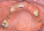 Figure 1B  Partially edentulous maxilla after placement of four implants in areas of adequate bone volume and subsequent placement of Locator implant attachments.