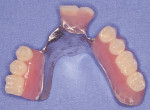 Figure 1D  Implant-retained, tissue-supported final prosthesis.