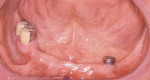 Figure 2C  Long-span unilateral edentulous mandibular ridge after placement of one implant to eliminate chronic lifting of the saddle with associated food impaction and mucosal soreness.