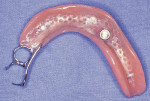 Figure 2D  Tissue surface of tooth- and implant-retained appliance with housing and retentive component cured into base.