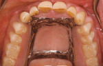 Figure 3D  Final prosthesis with uncompromised esthetics and retention. RPD created no detrimental forces to the remaining dentition.