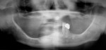 Figure 4A  Panoamic radiograph of a 70-year-old woman at initial patient presentation.