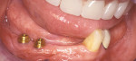Figure 4B  The long-span irregularly edentulous ridge of patient who was unable to tolerate her prosthesis before the placement of two implants to provide retention, limitation of rotation, and a level of occlusal support.