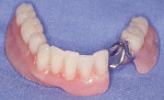 Figure 4D  Final tooth- and implant-retained appliance.