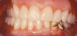 Figure 4E  Prosthesis in full occlusion opposing an existing maxillary full denture.
