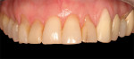 Figure 9  Discrepancies in gingival levels associated with recession. Note the long appearance of tooth No. 11.
